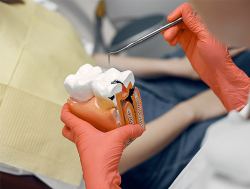 restorative-root-canal